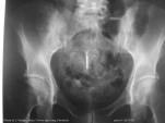 crosse-malposition1