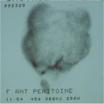 scintigraphie-fuite